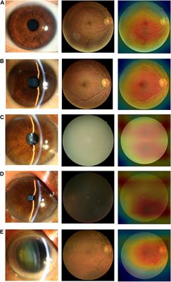 Deep learning for detecting visually impaired cataracts using fundus images